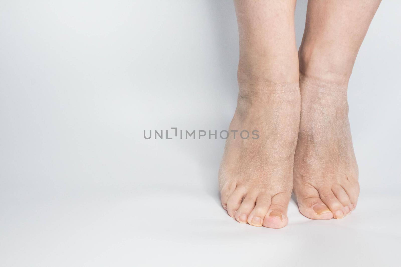 Close-up view female sore skin of feet, dry heels isolated on a white background