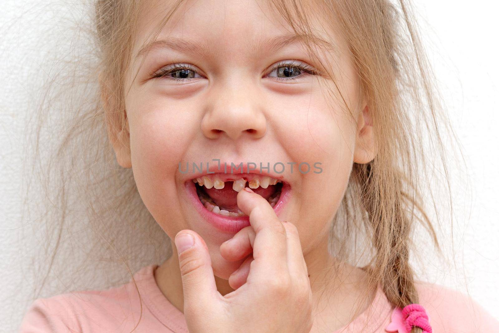 Happy and smiling caucasian little girl of 5-6 years touching loose tooth by finger looking at camera
