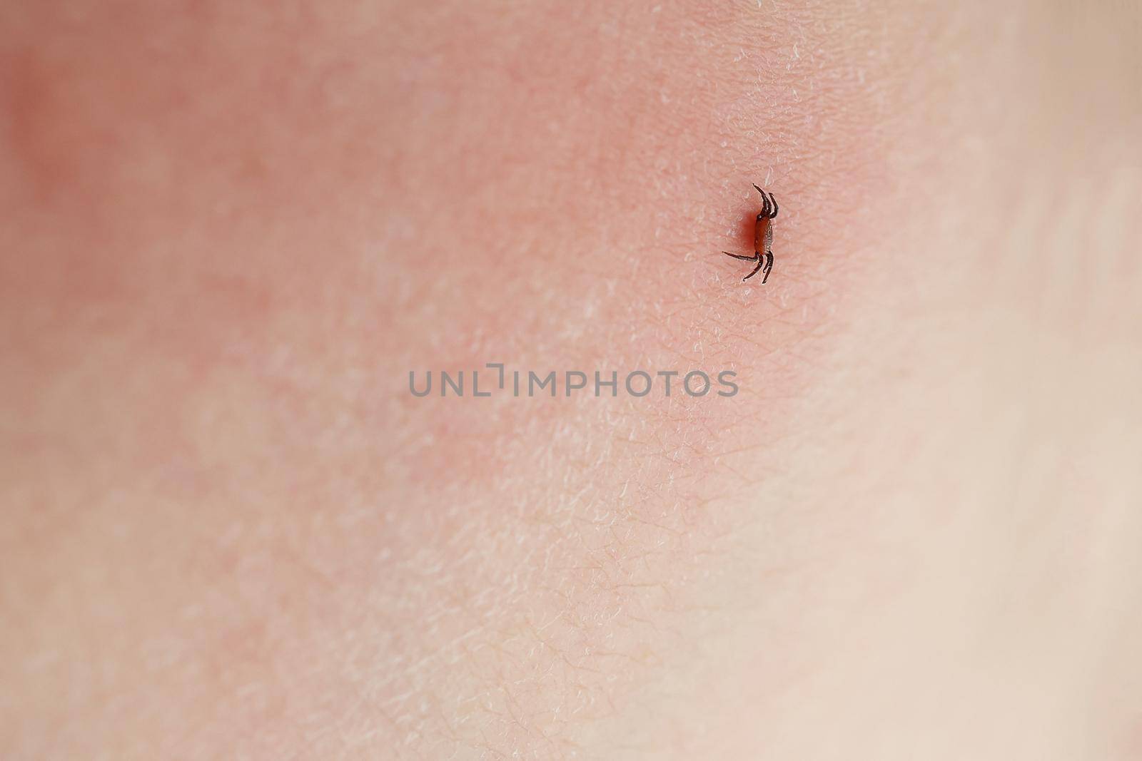 Dangerous insect tick. Ixodes ricinus tick sucking on human skin. A bloated parasite has bitten a man. Pink irritated epidermis. Encephalitis infection, Lyme disease. Selectiv focus