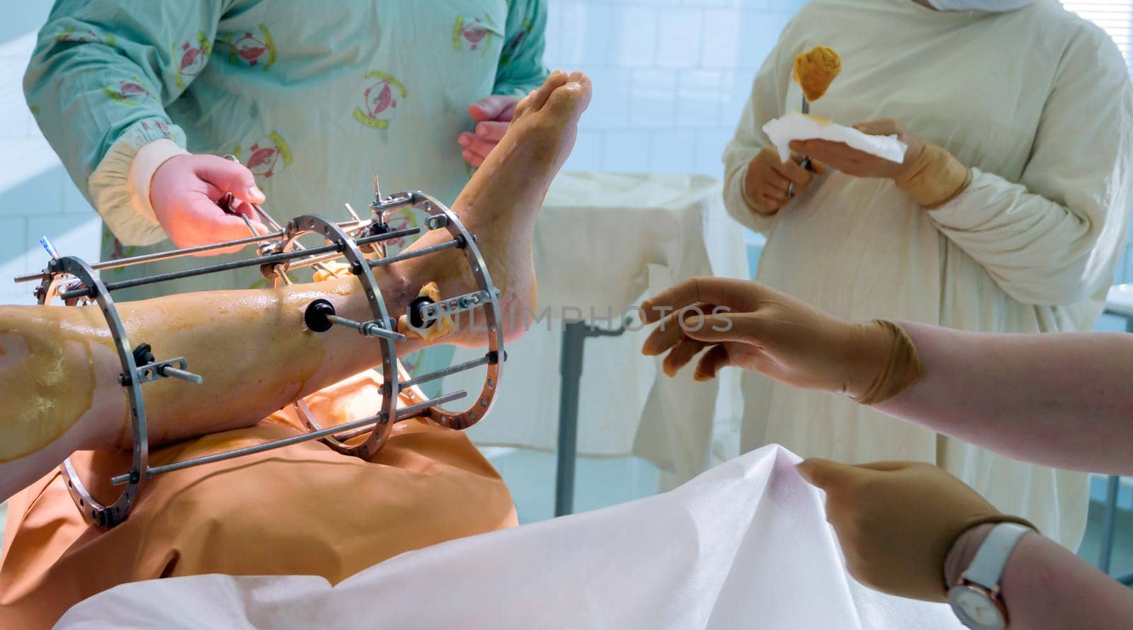 External ring fixation technique in orthopedic medicine