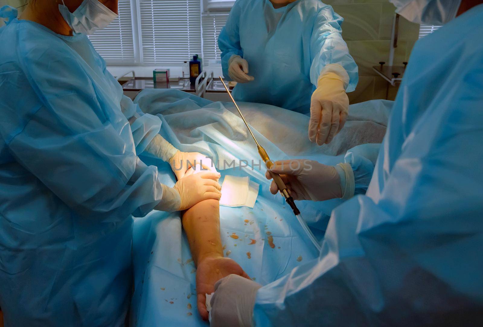 cosmetic liposuction surgery in actual operating room setting showing surgeon hands and cannula