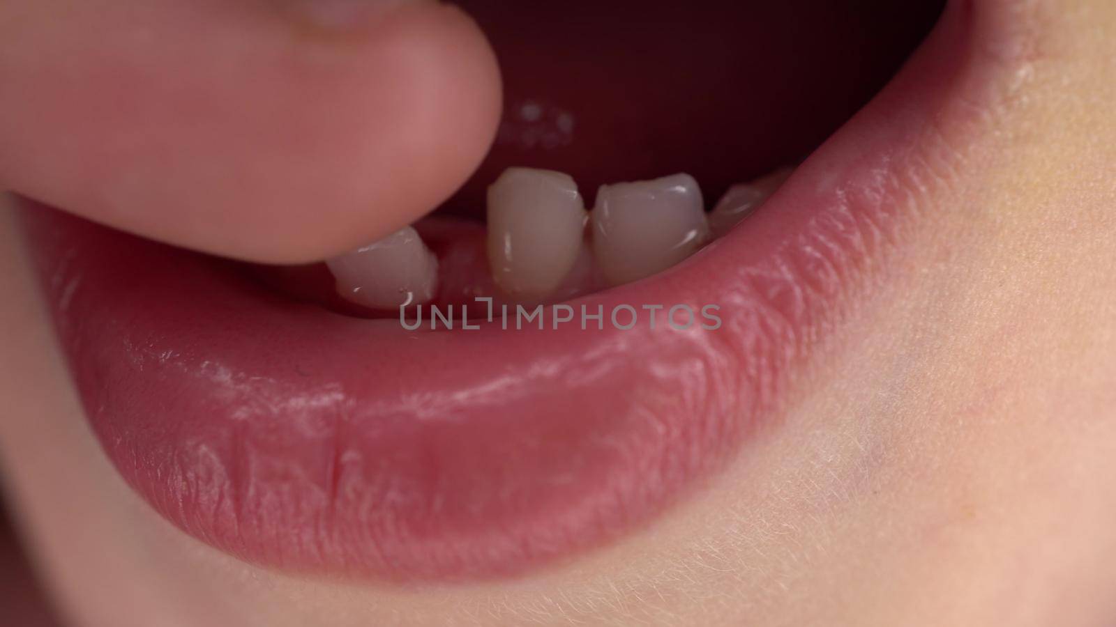 A small child has a loose milk tooth. Shaking tooth close-up. by Puzankov