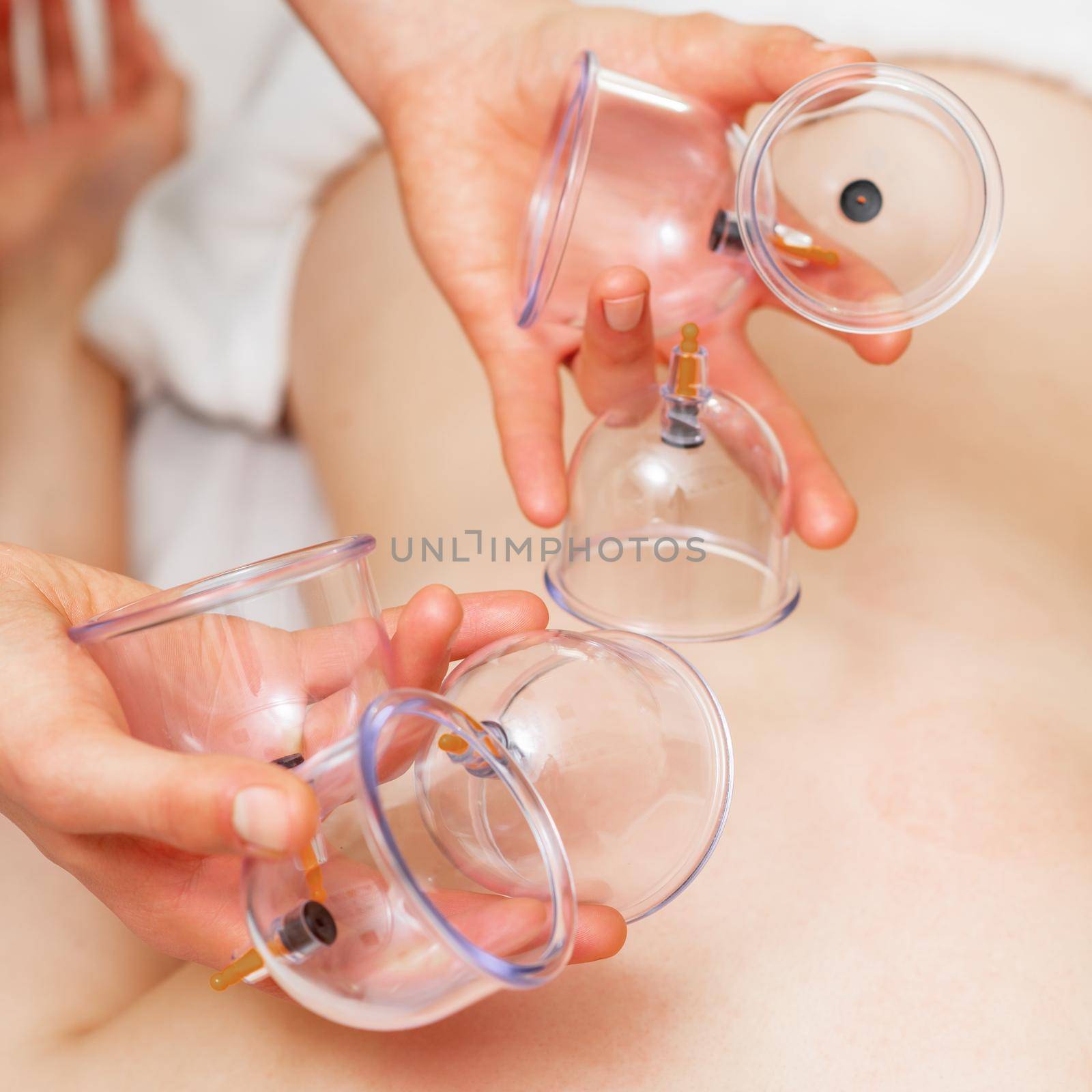 Hands of therapist holds vacuum cups above back of woman while medical cupping therapy.