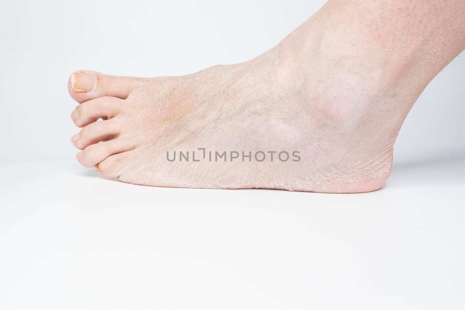 Close-up view female sore skin of feet, dry heels isolated on a white background