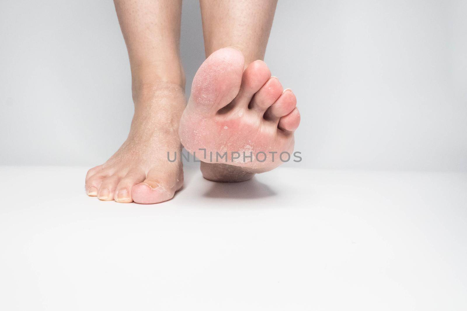 Close-up view female sore skin of feet, dry heels isolated on a white background
