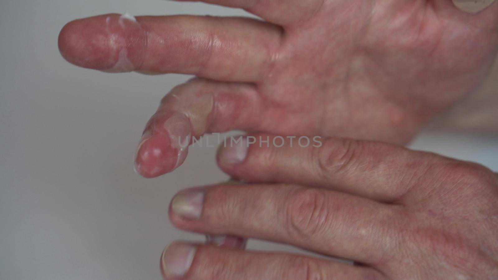 A man smeared ointment on his hand with a second-degree hot water burn. The skin is swollen with blisters. 4k