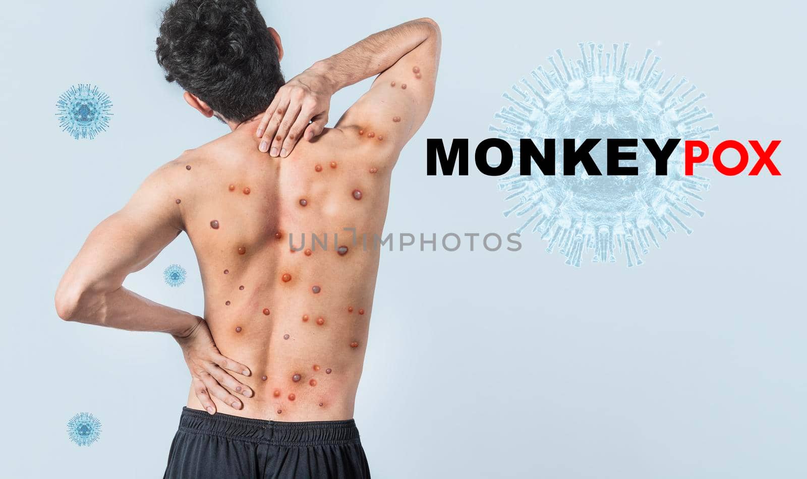 People with monkeypox on isolated background, A person from back with monkeypox on his body, Monkeypox virus concept, Monkeypox virus outbreak pandemic design