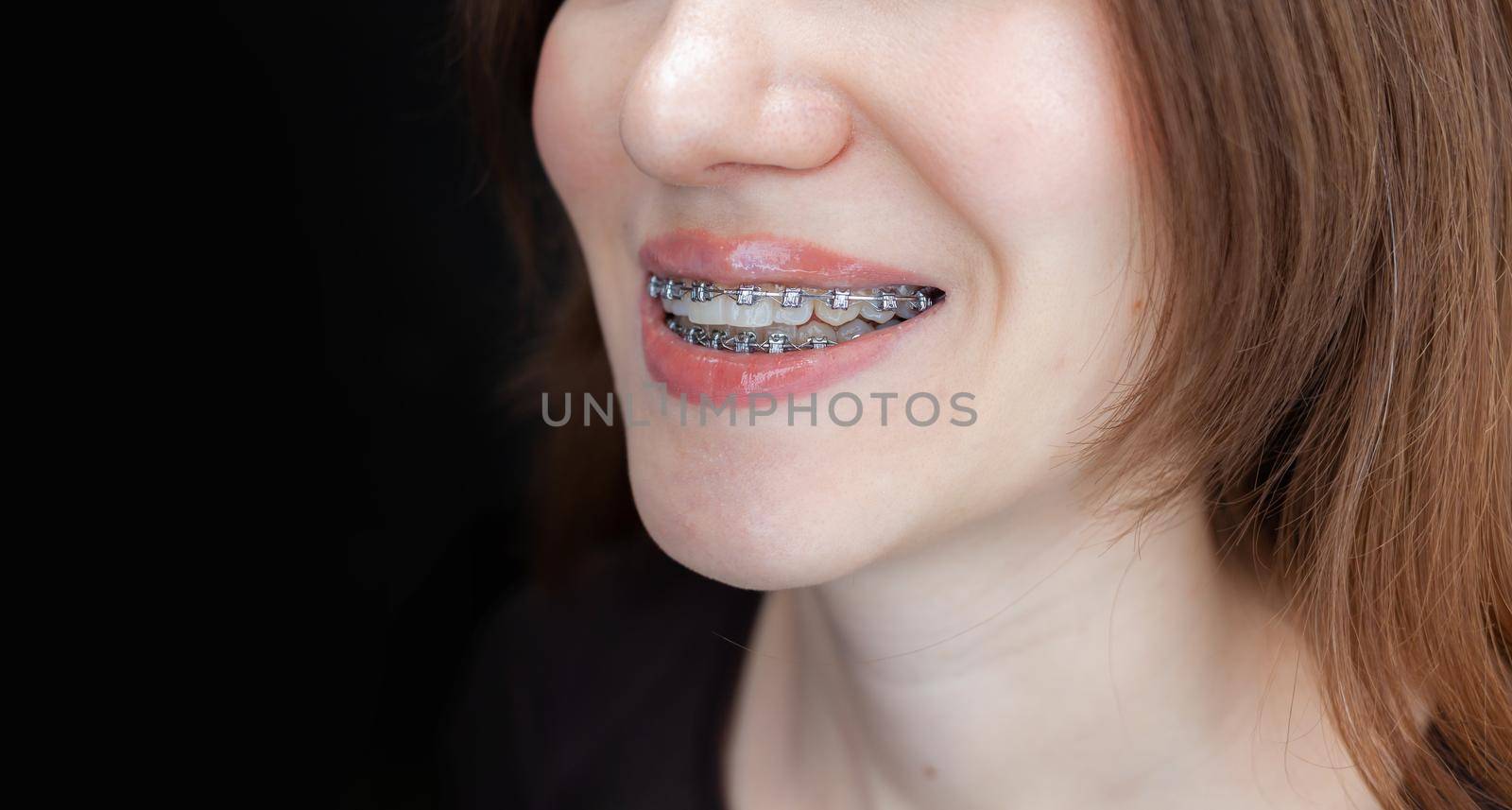 The smile of a young and beautiful girl with braces on her white teeth. Straightening of crooked teeth with the help of a bracket system. Malocclusion. Dental care. Smooth teeth and a beautiful smile