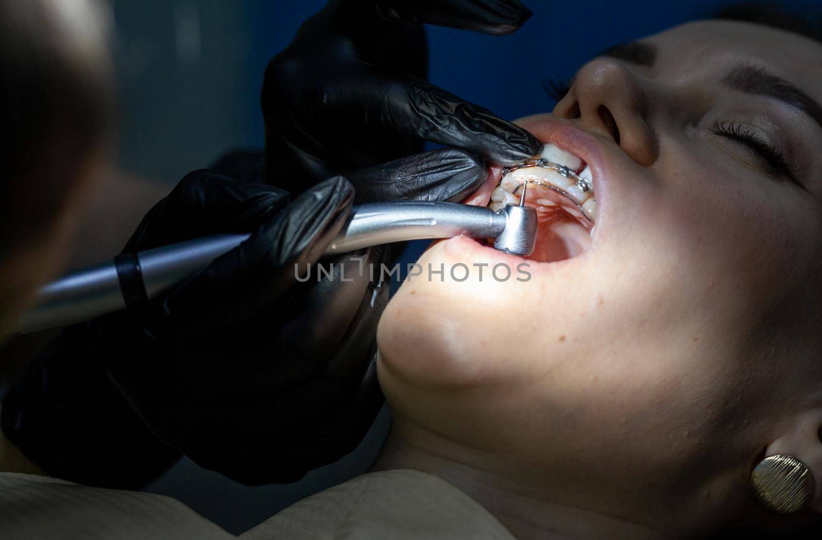 The process of removing braces.Beautiful woman in dental chair during procedure of installing braces to upper and lower teeth. Dentist and assistant working together, dental tools in their hands.