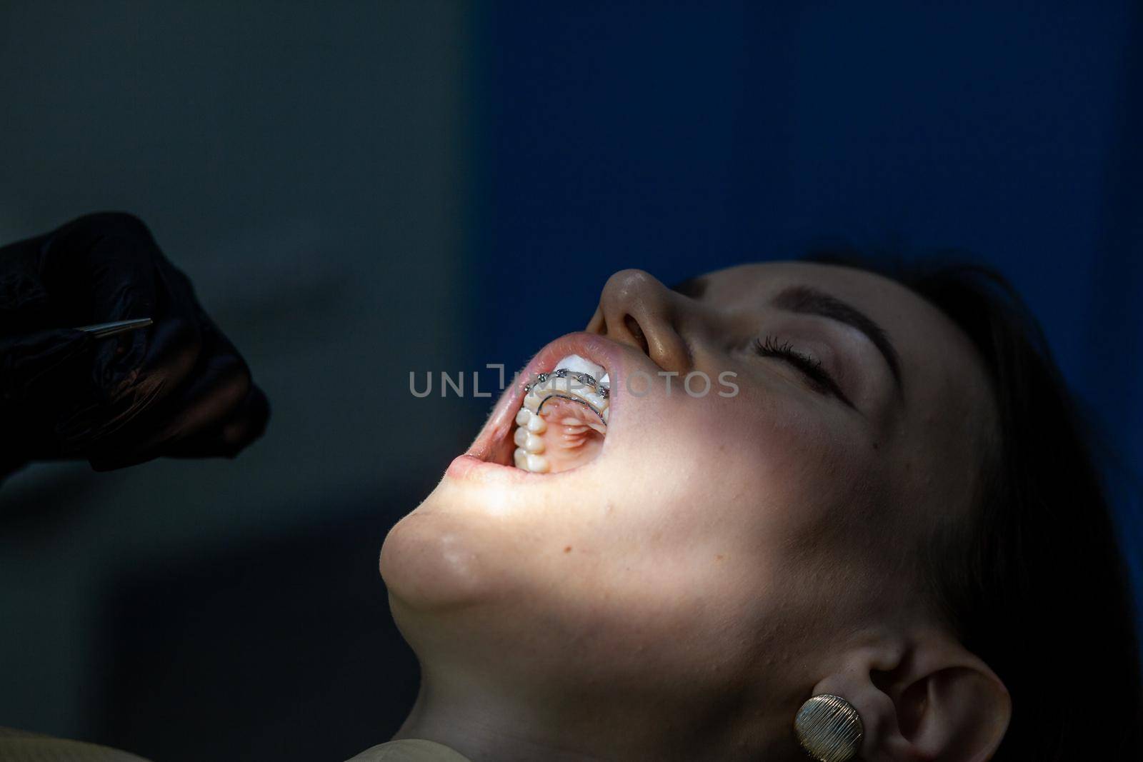 Installing a retainer after wearing braces. The process of removing braces.Beautiful woman in dental chair during procedure of installing braces to upper and lower teeth. Dentist and assistant working