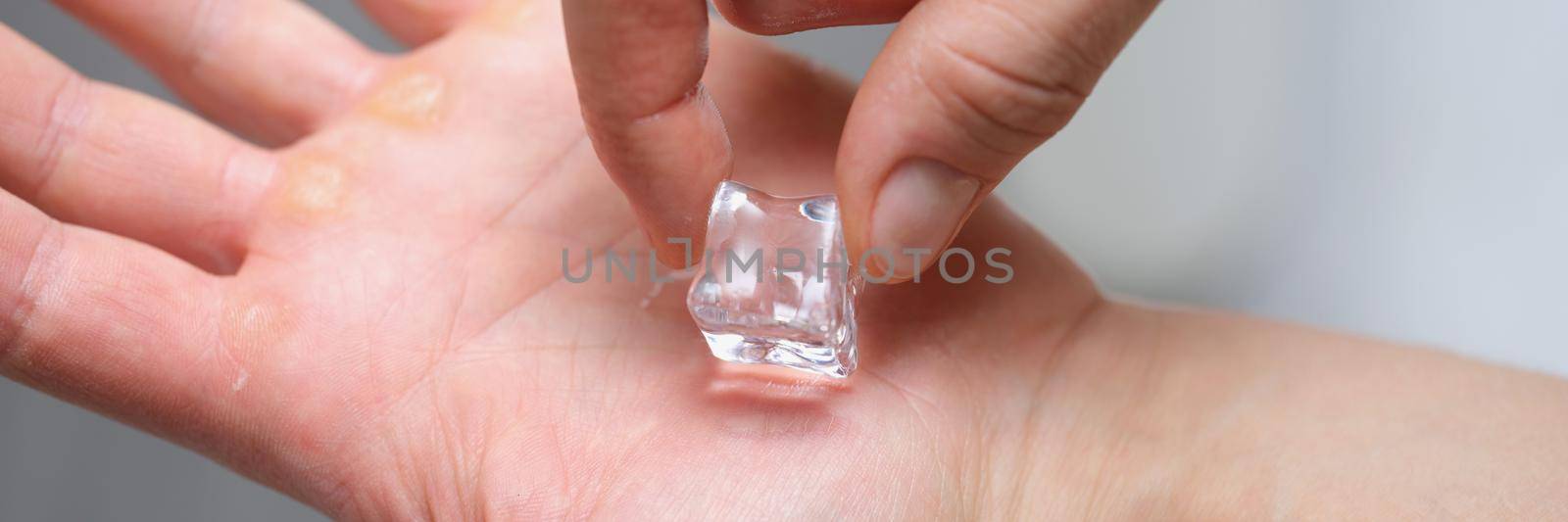 A piece of ice on the palm of a man, calluses on his hands, close-up. Rubbing the corn with ice. Dry skin, pain relief