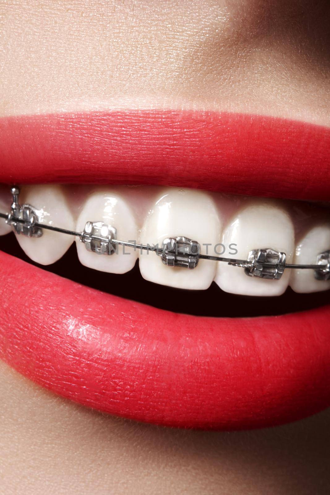 Beautiful macro shot of white teeth with braces. Beauty woman smile with red lips and ortodontic accessories. Orthodontics treatment. Closeup of healthy female mouth