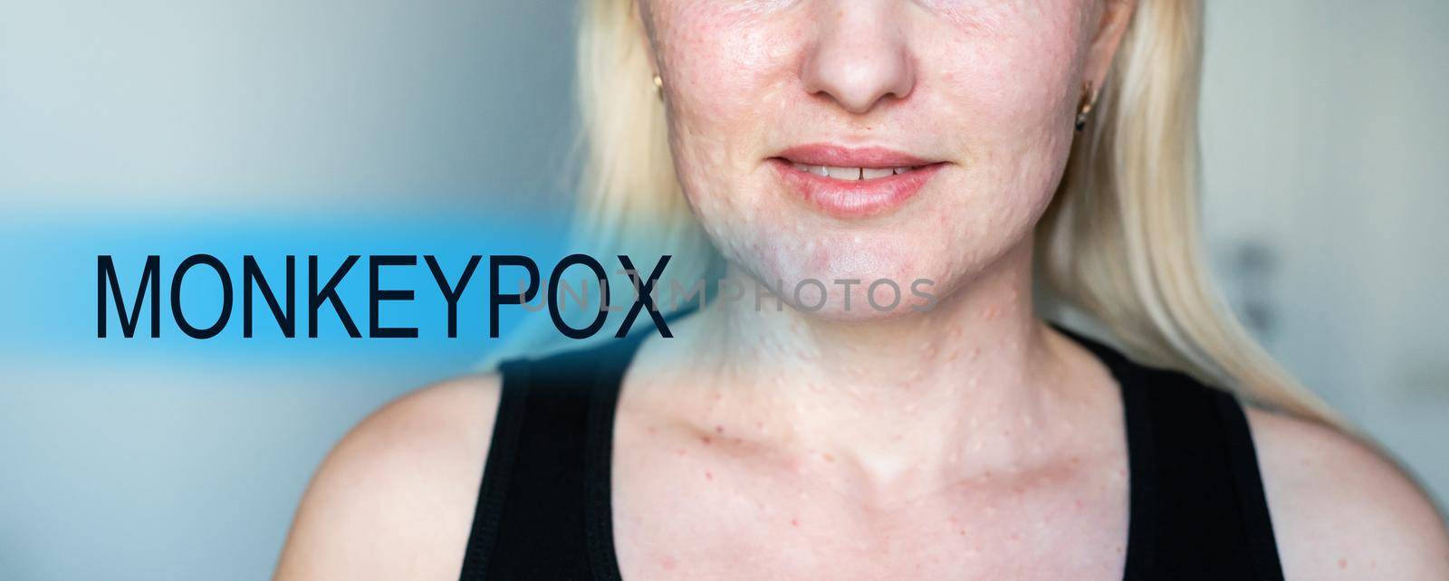 woman papules face, skin texture of woman. by Andelov13