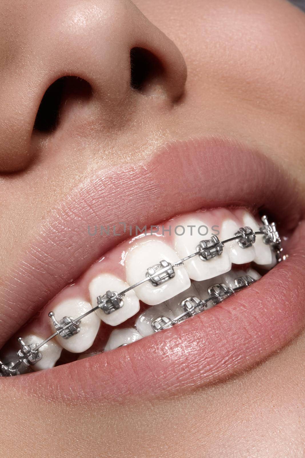 Beautiful macro shot of white teeth with braces. Dental care photo. Beauty woman smile with ortodontic accessories. Orthodontics treatment. Closeup of healthy female mouth