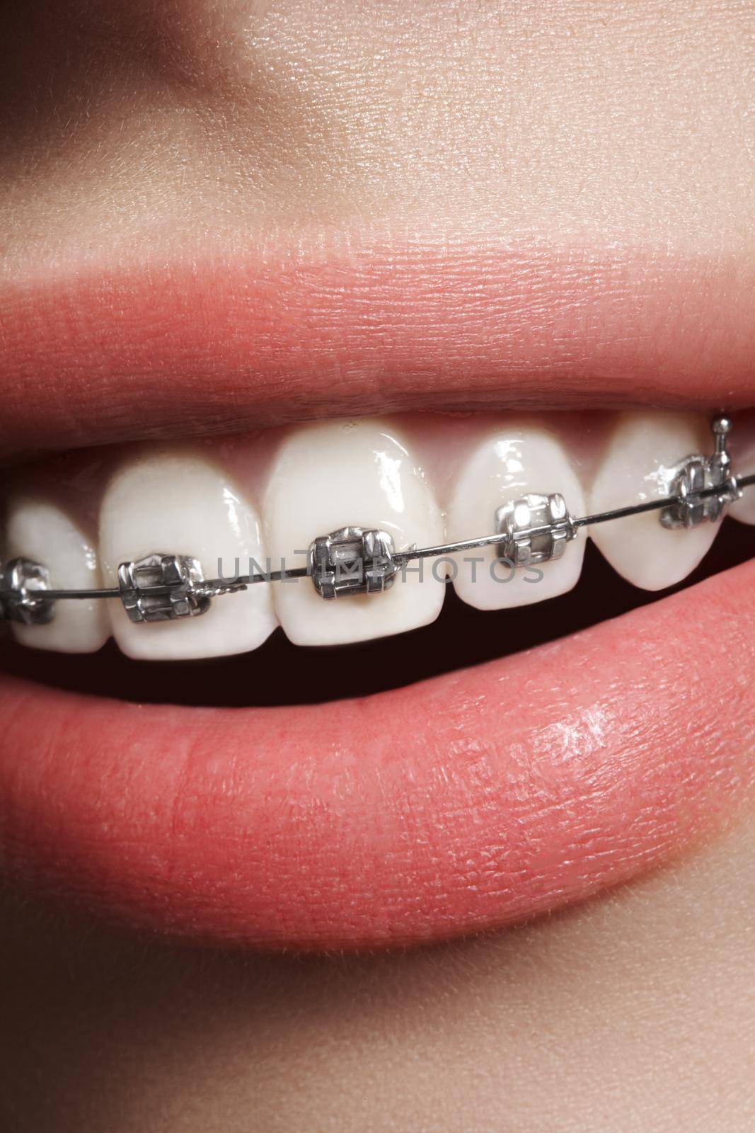 Beautiful white teeth with braces. Dental care photo. Woman smile with ortodontic accessories. Orthodontics treatment by MarinaFrost