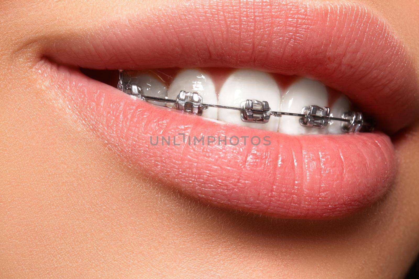 Beautiful macro shot of white teeth with braces. Dental care photo. Beauty woman smile with ortodontic accessories. Orthodontics treatment. Closeup of healthy female mouth