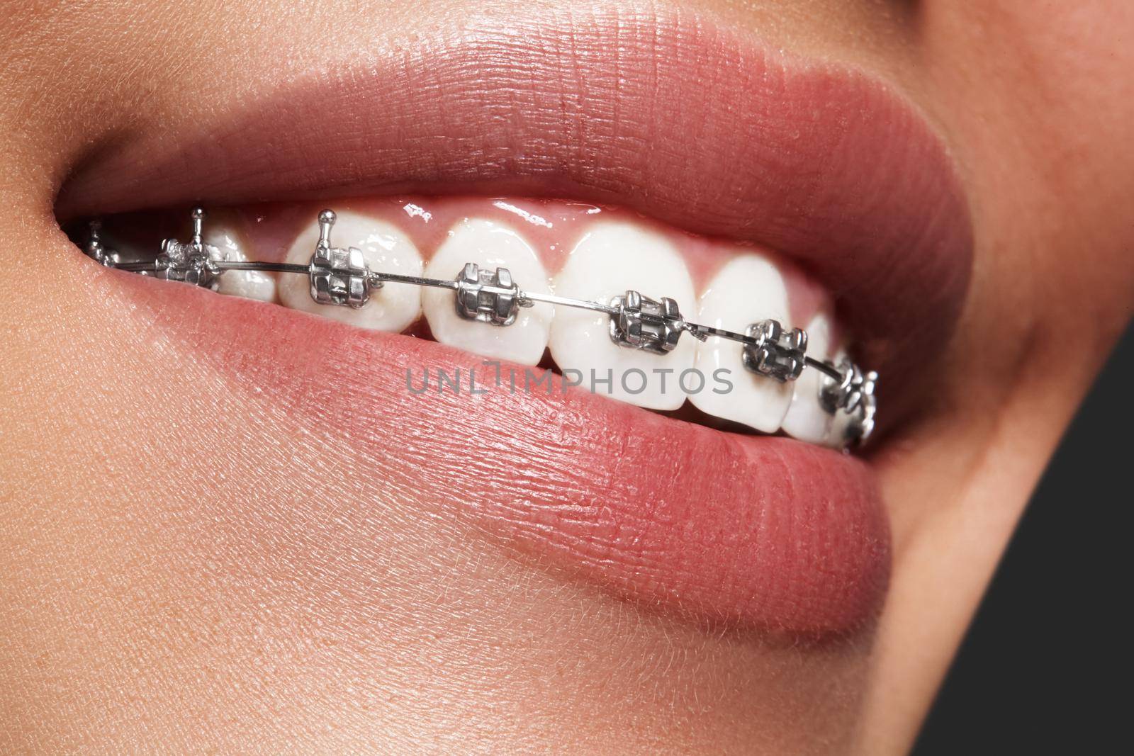 Beautiful macro shot of white teeth with braces. Dental care photo. Beauty woman smile with ortodontic accessories. Orthodontics treatment. Closeup of healthy female mouth