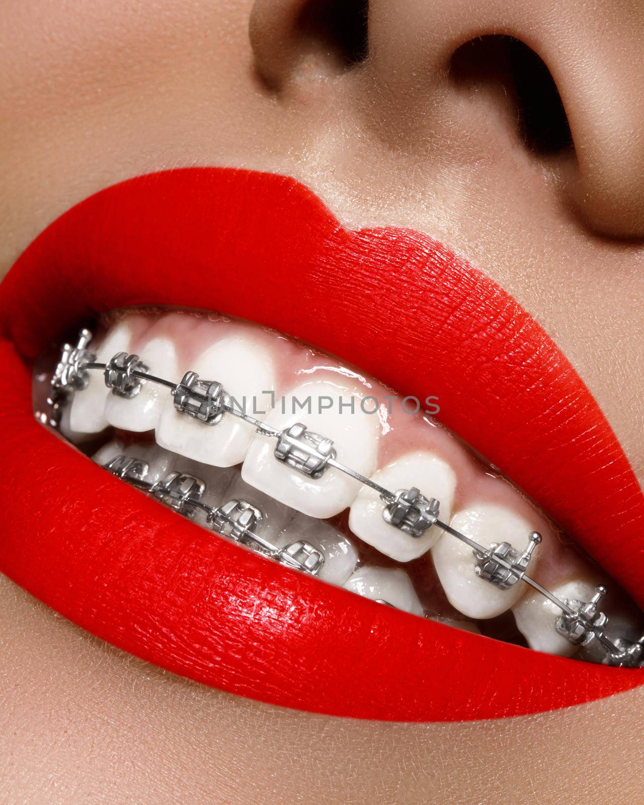 White teeth with braces. Dental care photo. Woman smile with ortodontic accessories, bright lips. Orthodontics treatment by MarinaFrost