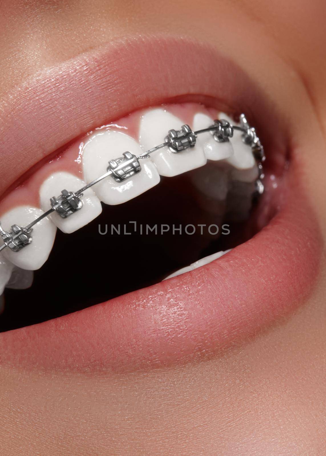 Beautiful macro shot of white teeth with braces. Dental care photo. Beauty woman smile with ortodontic accessories. Orthodontics treatment. Closeup of healthy female mouth