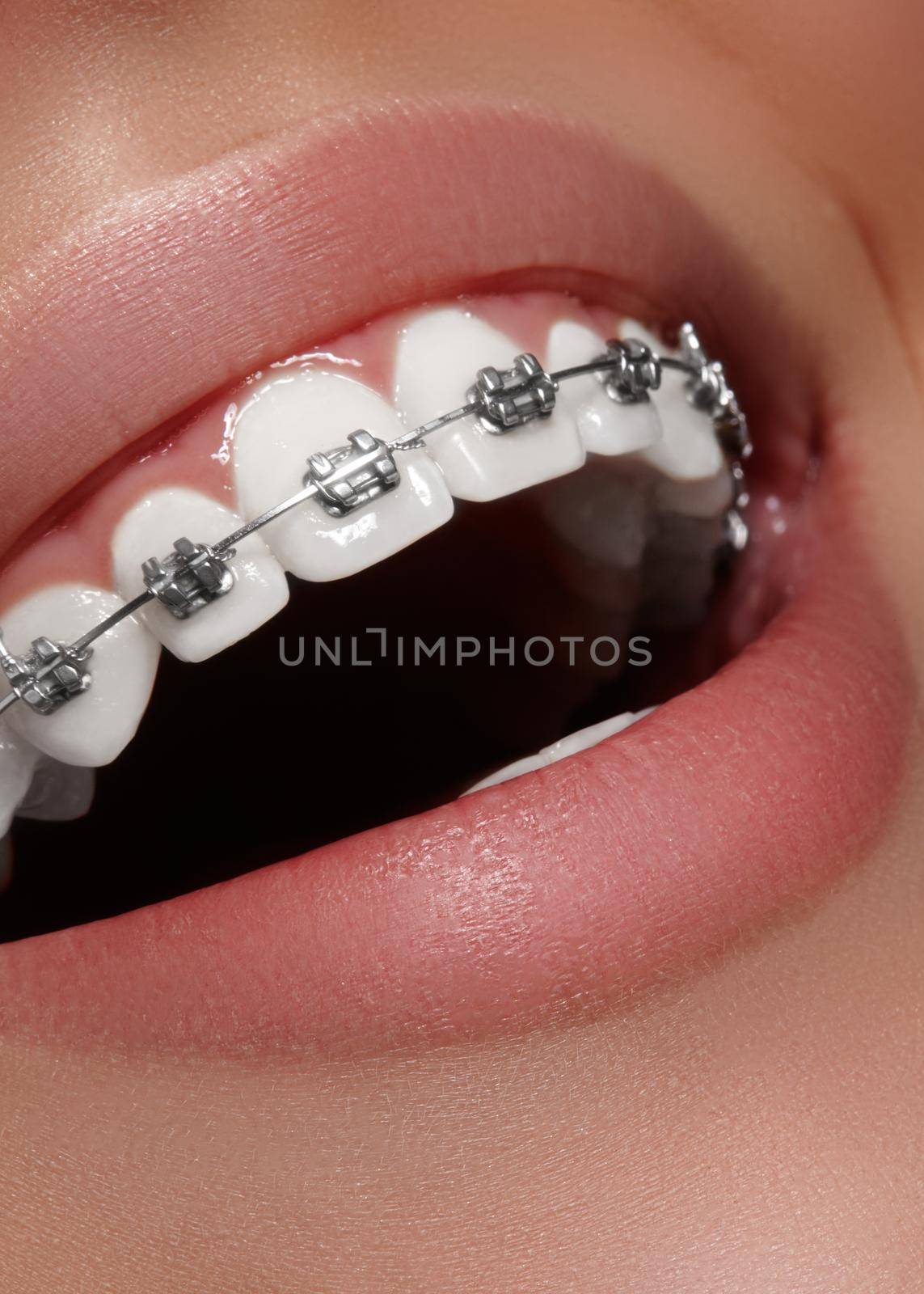 Beautiful white teeth with braces. Dental care photo. Woman smile with ortodontic accessories. Orthodontics treatment by MarinaFrost