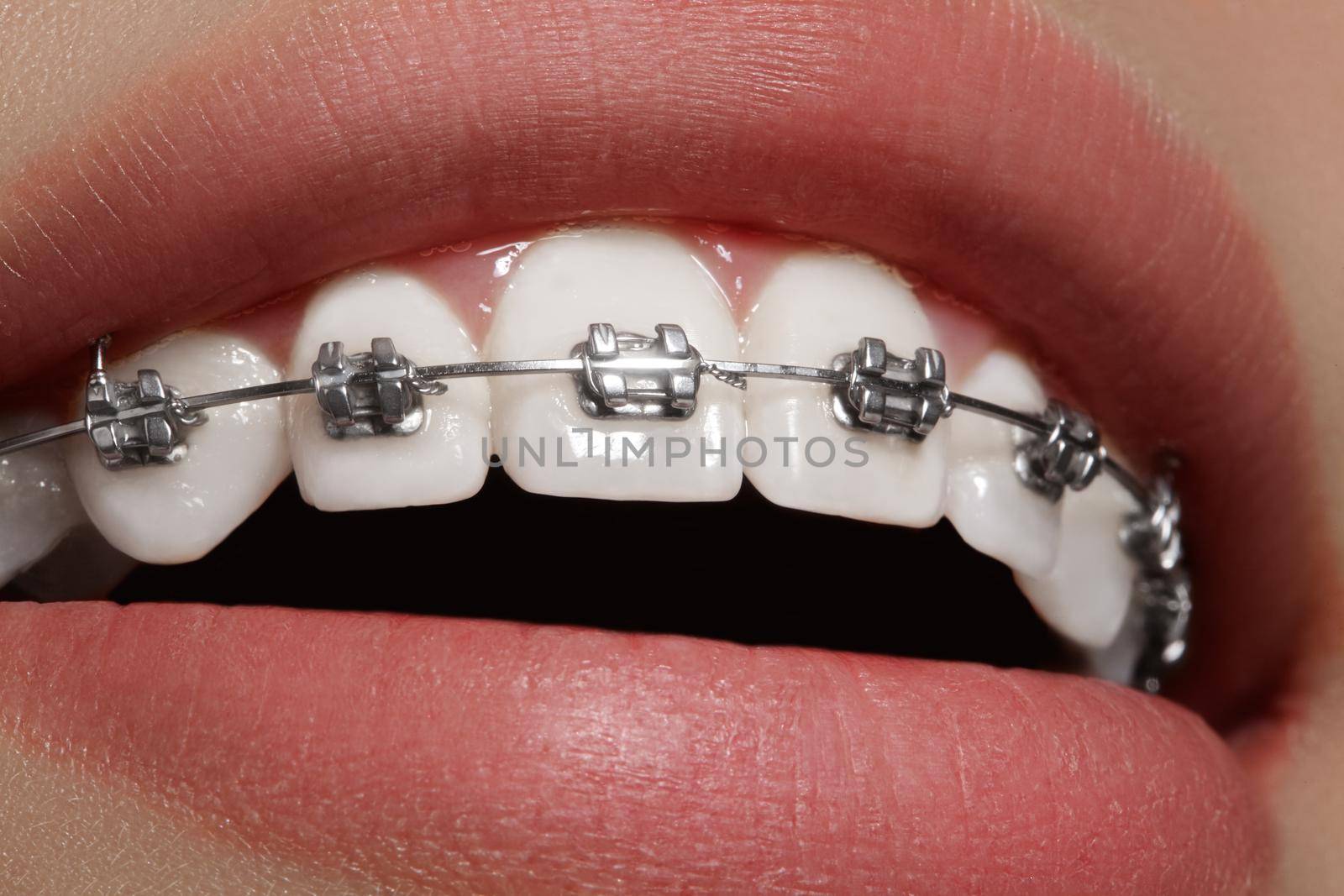 Beautiful white teeth with braces. Dental care photo. Woman smile with ortodontic accessories. Orthodontics treatment by MarinaFrost