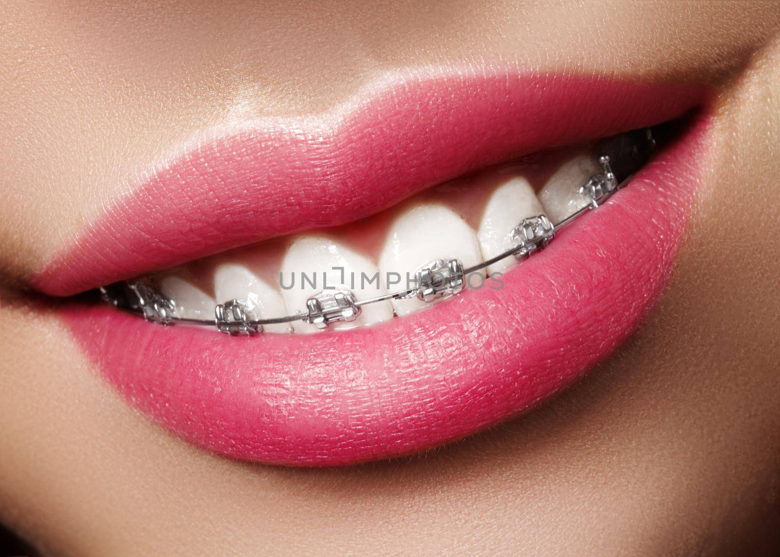 Beautiful Macro Close-up of White Teeth with Braces. Dental Care Photo. Beauty Woman Smile with Ortodontic Accessories. Orthodontics Treatment. Closeup of Healthy Female Mouth