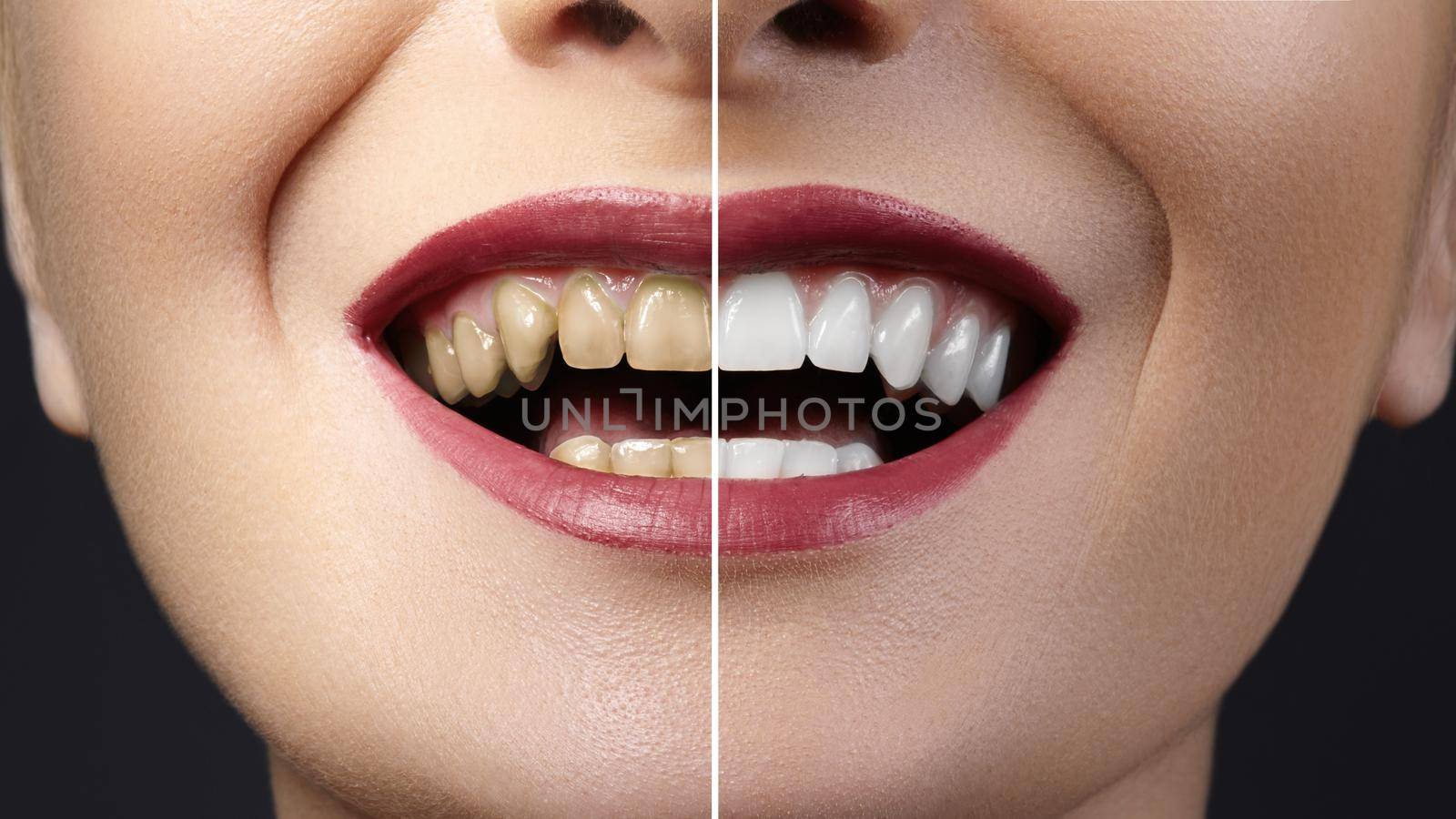 Before and after whitening treatment or dental veneers on teeth. Health Care collage of human mouth. Caries therapy by MarinaFrost