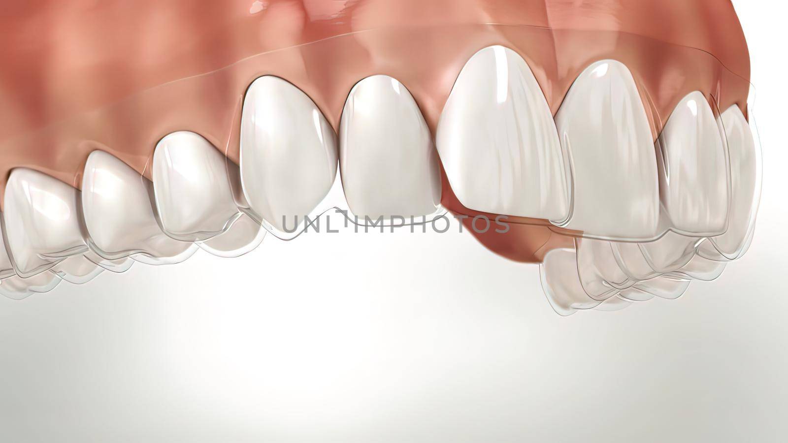 Invisalign braces or invisible retainer make bite correction. Medically accurate .3D illustration