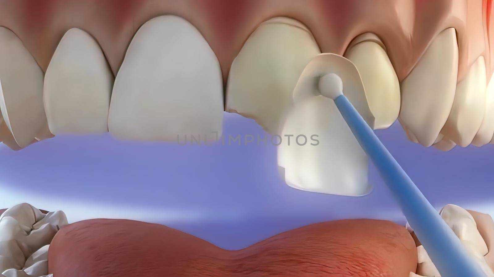 The process of chipping damaged teeth . 3D illustration