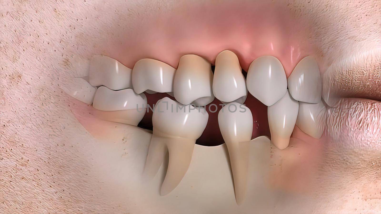 Disruption of teeth structure Realistic medical animated by creativepic