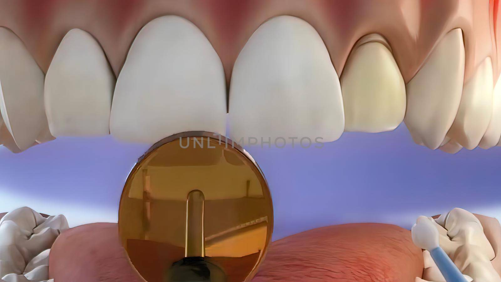 Tooth coating process, drying with adhesive beam 3D illustration