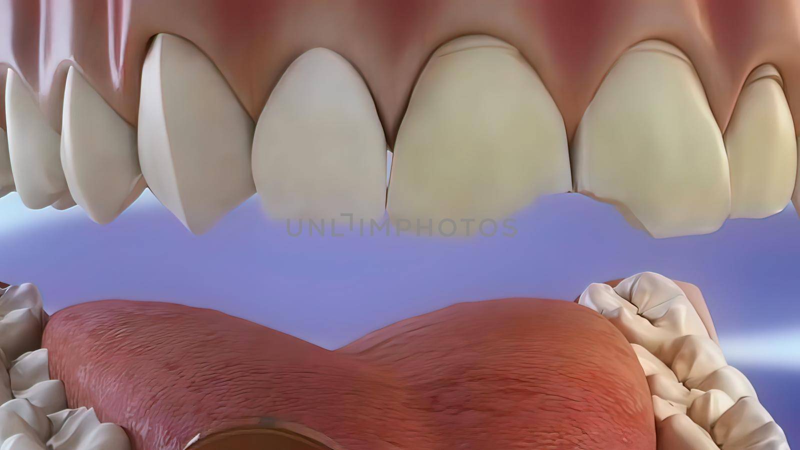 The process of chipping damaged teeth . 3D illustration