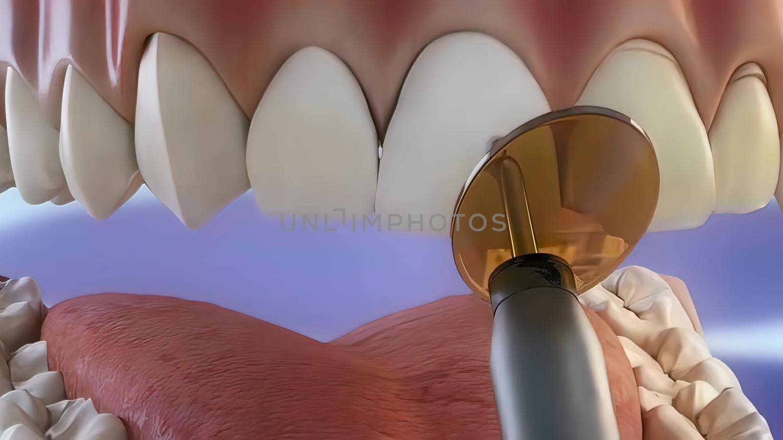 Tooth coating process, drying with adhesive beam 3D illustration