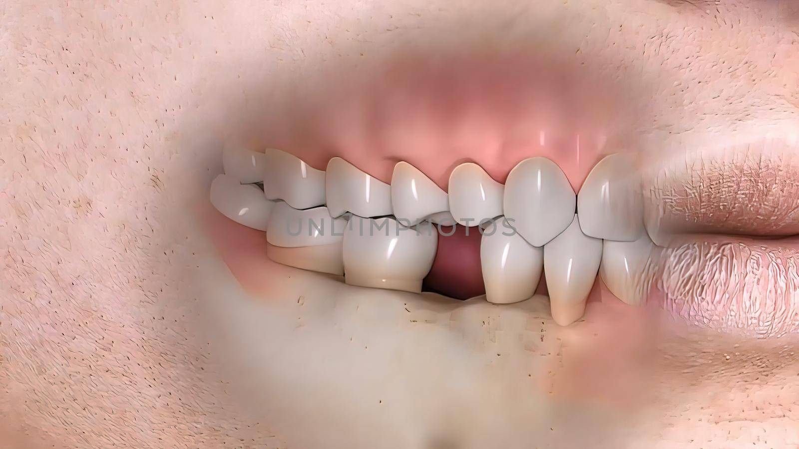 Disruption of teeth structure Realistic medical animated by creativepic