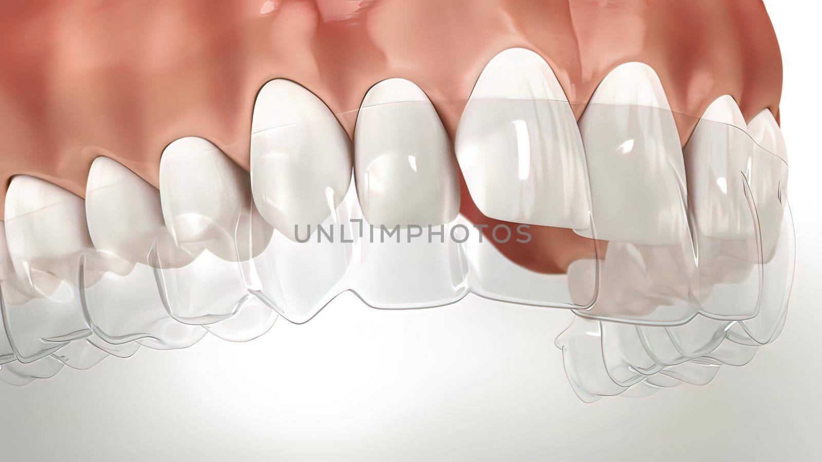 Invisalign braces or invisible retainer make bite correction. Medically accurate by creativepic