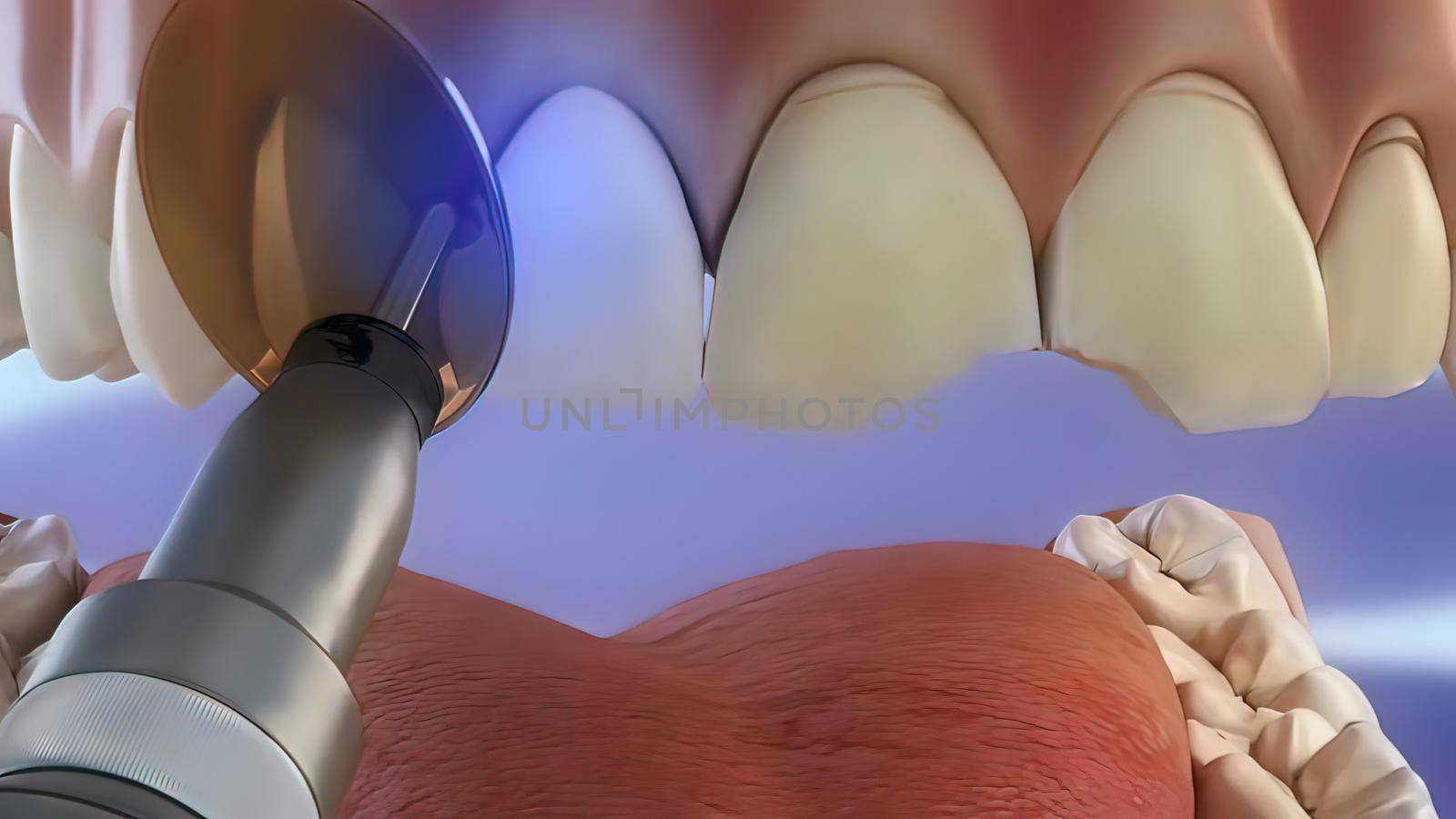 Tooth coating process, drying with adhesive beam 3D illustration