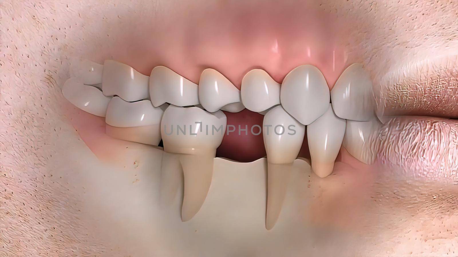 Disruption of teeth structure Realistic medical animated by creativepic