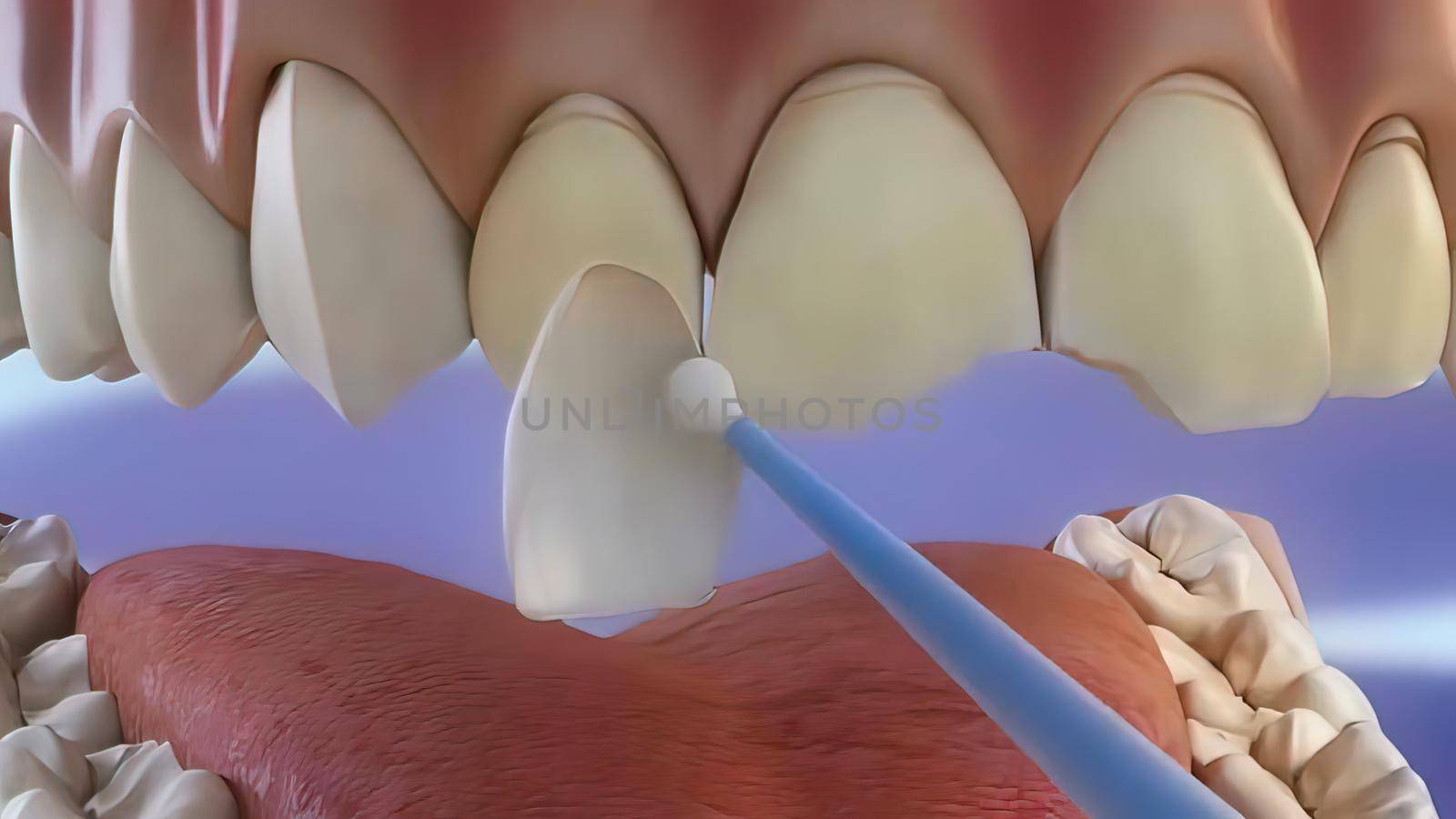 The process of chipping damaged teeth . 3D illustration