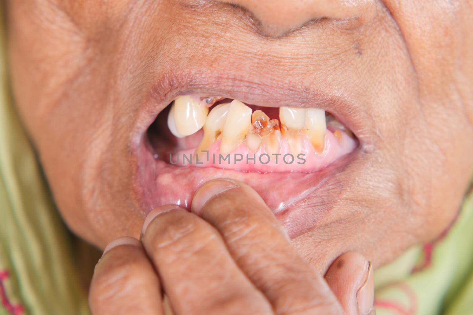 Senior Woman Smiling With Deformed Teeth by towfiq007