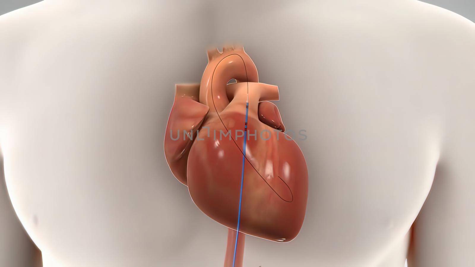 heart stent insertion process by creativepic