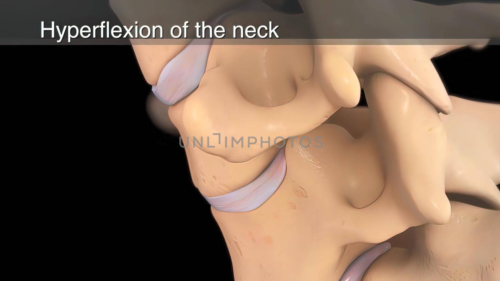 hyperflexion of the neck 3d illustration