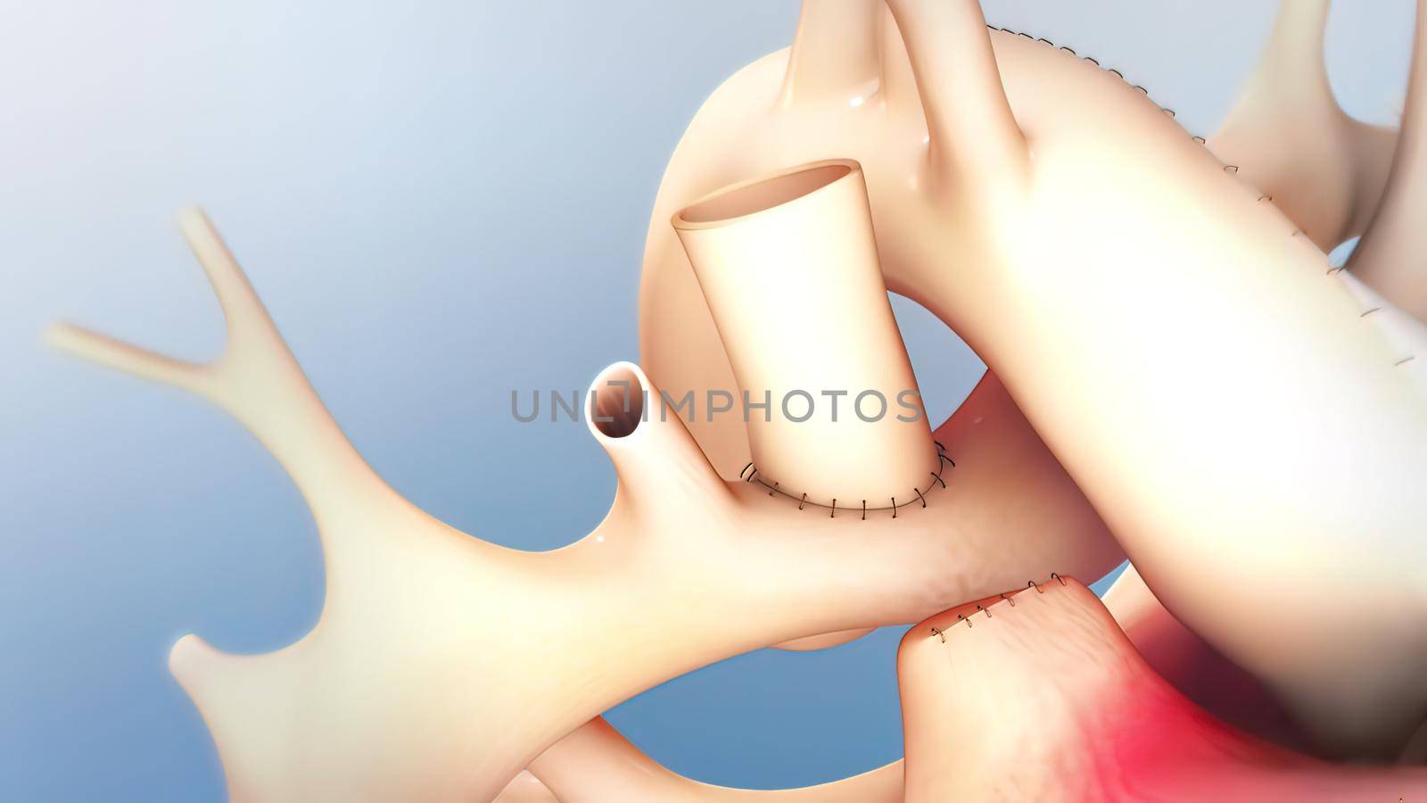 The Cardiovascular system. Hypoplastic left heart syndrome by creativepic