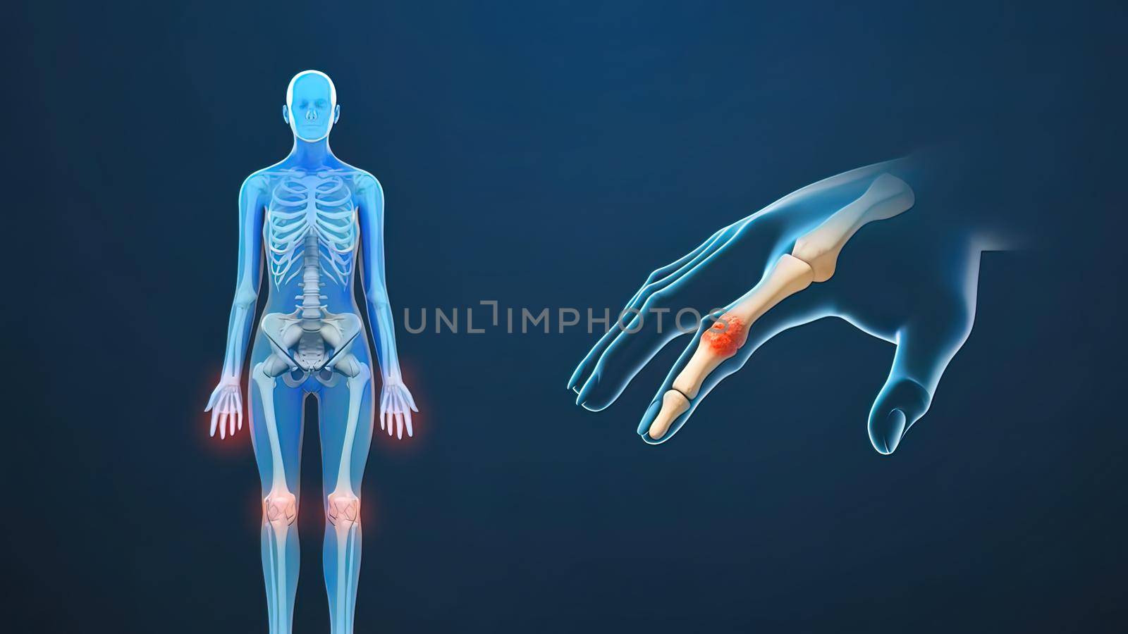 joint pain, rheumatoid arthritis and osteoarthritis by creativepic