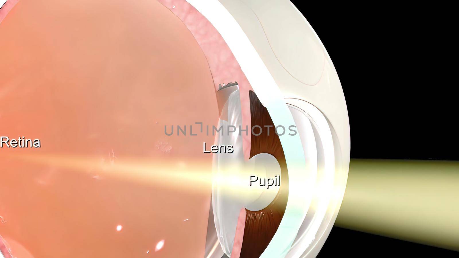 Anatomy of the Eye. Loss of vision in the eye by creativepic