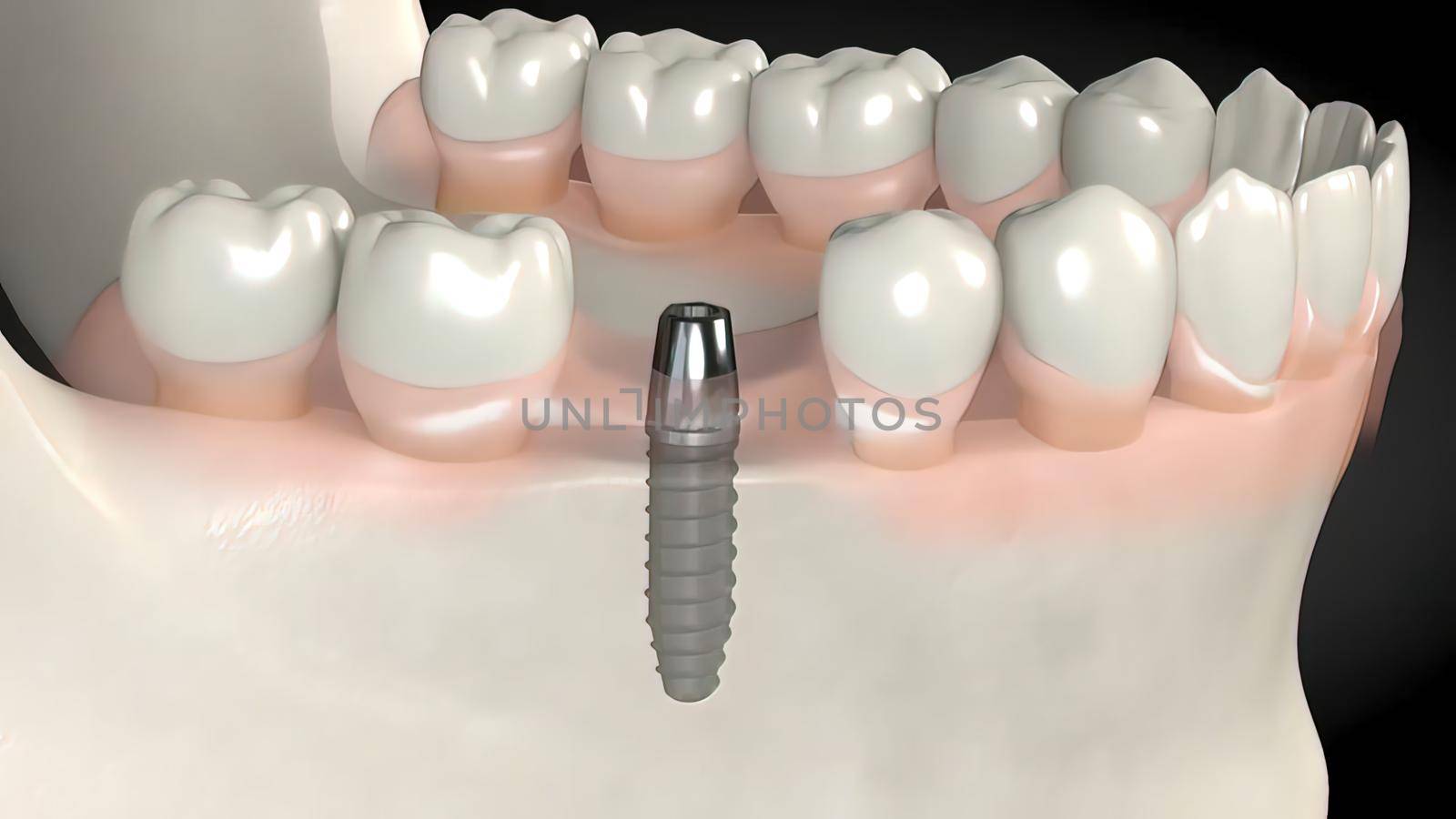 Dental implant surgery. by creativepic