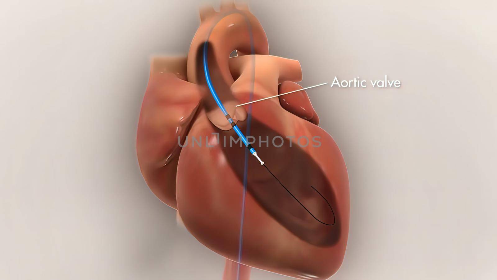 of balloon angioplasty with stent procedure used to widen artery blocked by cholesterol plaque, a common intervention in case of heart attack. Also available version without stent.3D illustration