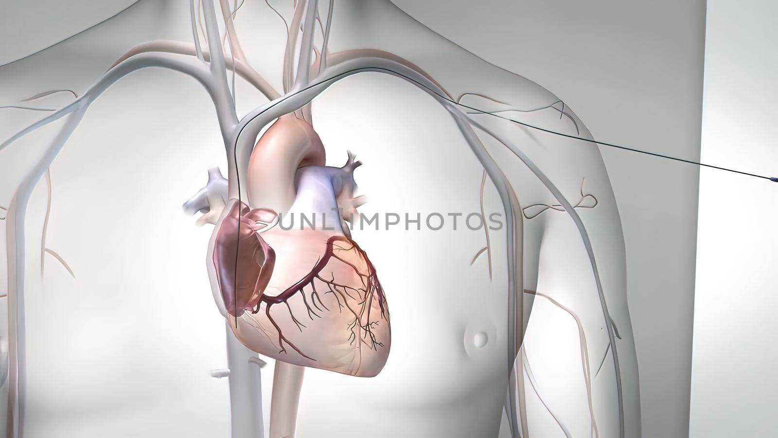 Coronary artery bypass grafting (CABG) is a type of surgery that improves blood flow to the heart. Its used for people who have severe coronary heart disease.3D illustration