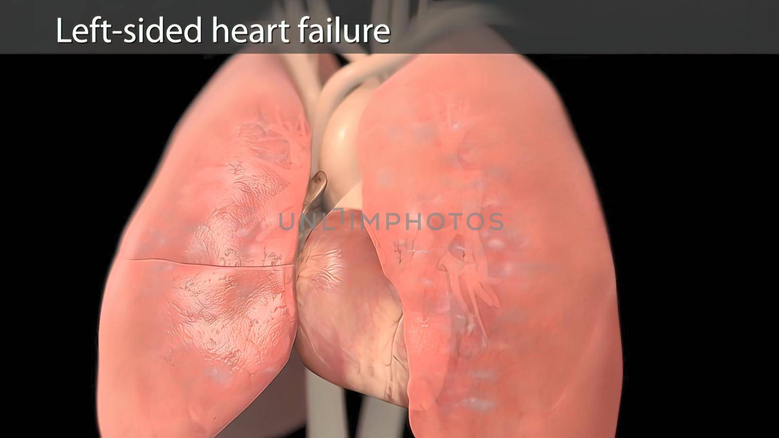 left sided heart failure 3D illustration