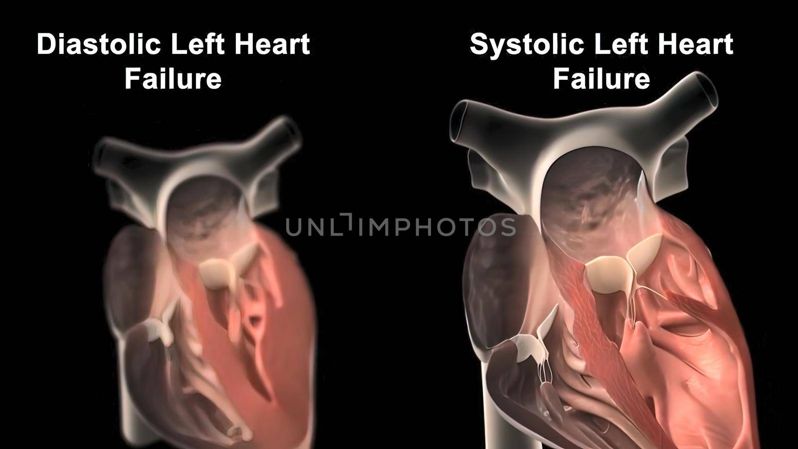 3D Animated right-sided heart failure - beating heart 3D illustration