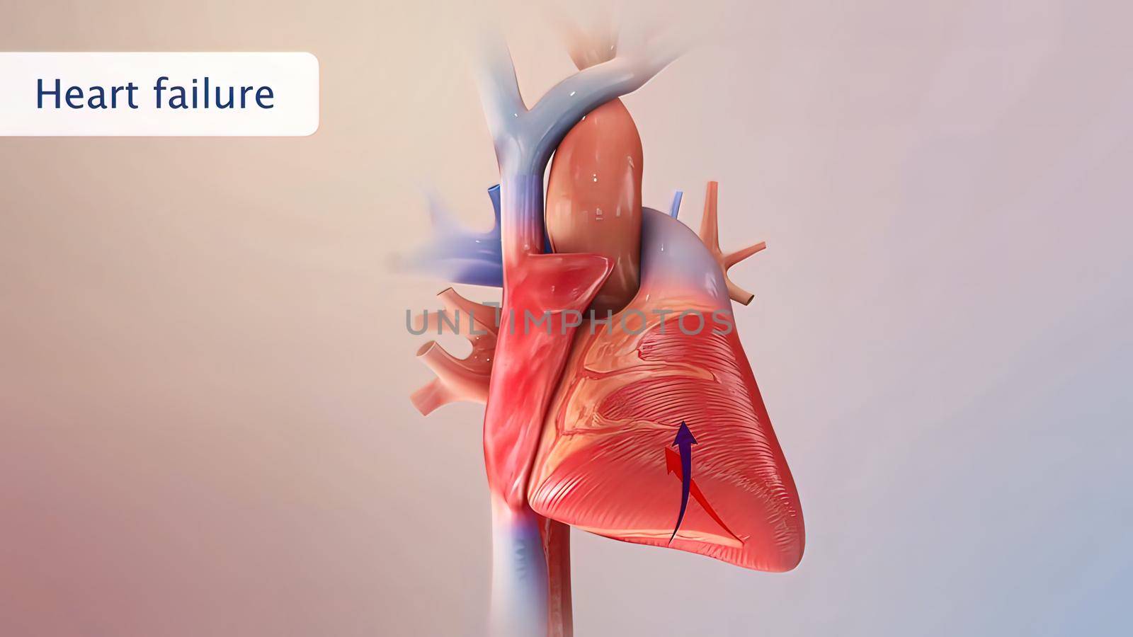 Heart failure means that the heart is unable to pump blood around the body properly. 3D illustration